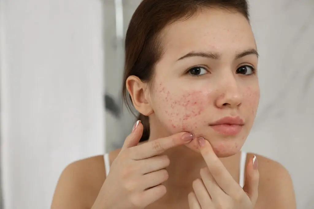 Get Rid of Pimple Scab