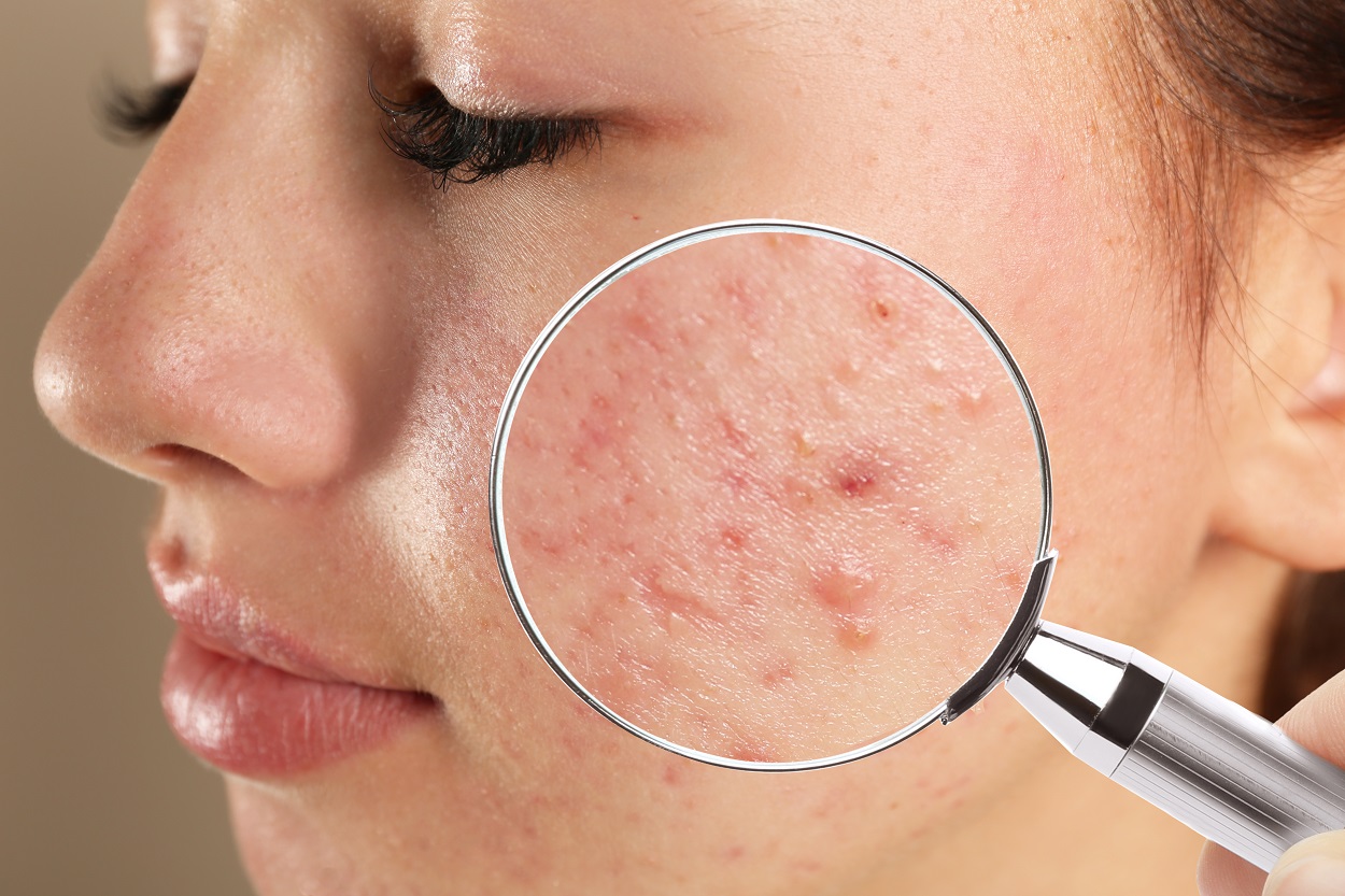 Pimples get of who rid overnight to How Exactly